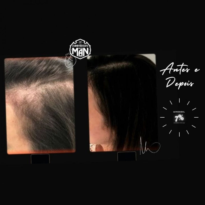 Minoxidil 7% 30ml - Fórmula Exclusiva Calvície e Alopecia