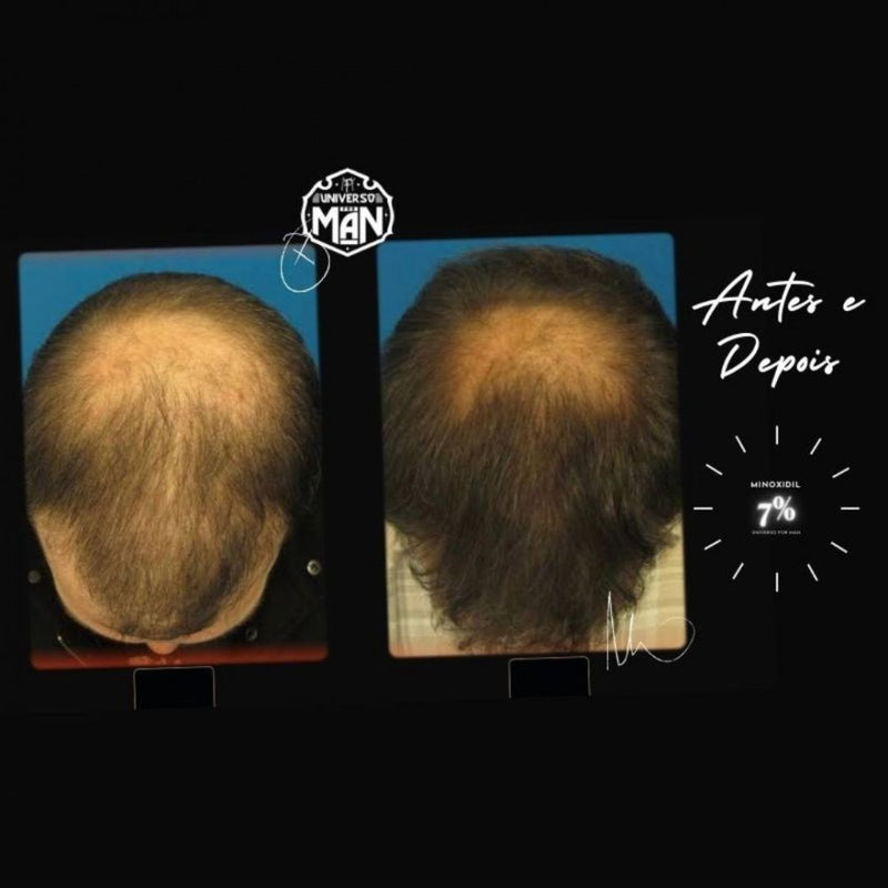 Minoxidil 7% 30ml - Fórmula Exclusiva Calvície e Alopecia