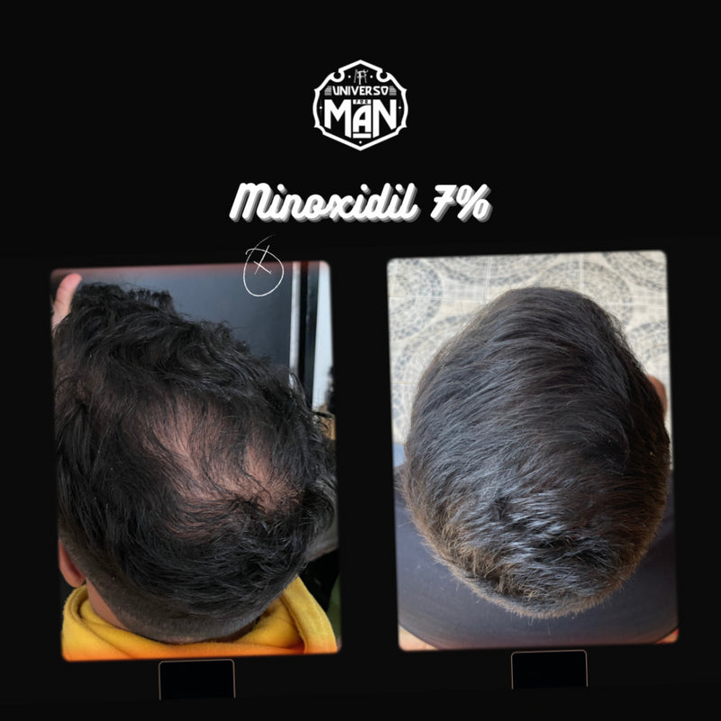 Minoxidil 7% 30ml - Fórmula Exclusiva Calvície e Alopecia