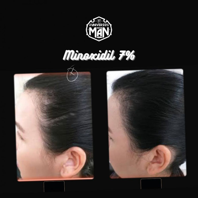 Minoxidil 7% 30ml - Fórmula Exclusiva Calvície e Alopecia