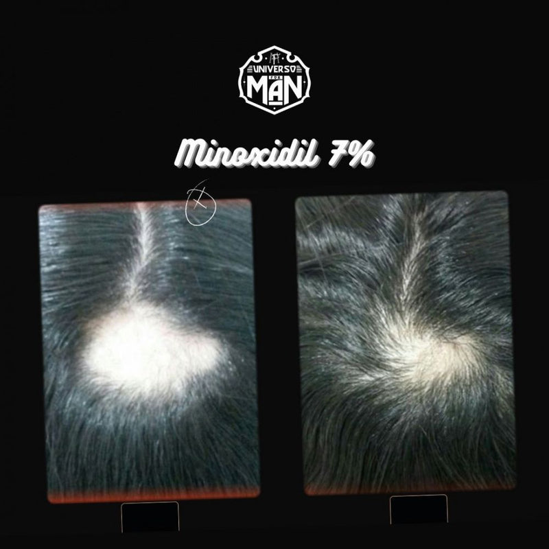 Minoxidil 7% 30ml - Fórmula Exclusiva Calvície e Alopecia